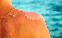 Dermatitis solaris, better known as common sunburn Dermatitis solaris, better known as common sunburn